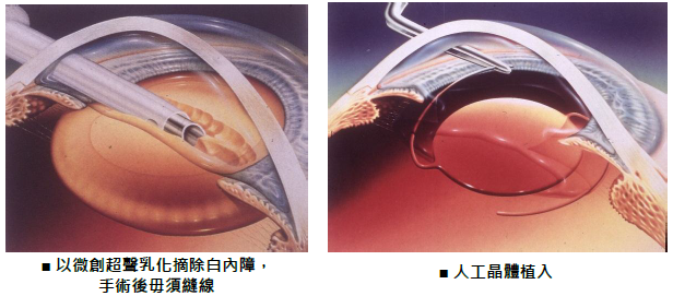 白內(nèi)障,?，斎鹨曆劭?上海眼科醫(yī)院