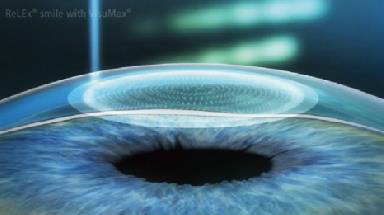 屈光矯視,?，斎鹨曆劭?上海眼科醫(yī)院