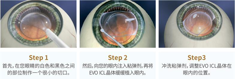 屈光矯視,希瑪瑞視眼科,上海眼科醫(yī)院