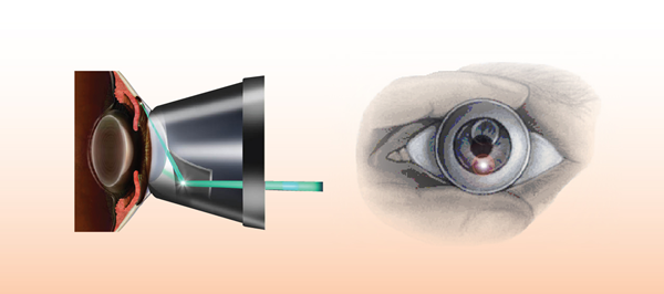 青光眼,?，斎鹨曆劭?上海眼科醫(yī)院