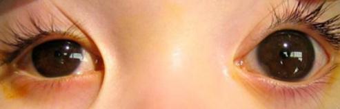 眼眶病,希瑪瑞視眼科,上海眼科醫(yī)院