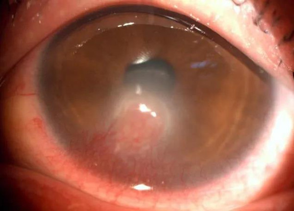 眼表眼角膜,?，斎鹨曆劭?上海眼科醫(yī)院