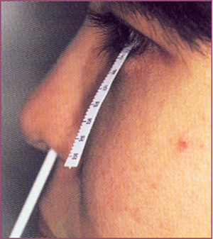 眼表眼角膜,?，斎鹨曆劭?上海眼科醫(yī)院