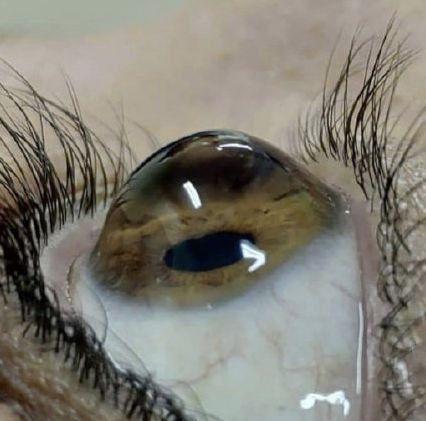 眼表眼角膜,?，斎鹨曆劭?上海眼科醫(yī)院