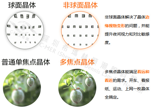 白內(nèi)障,?，斎鹨曆劭?上海眼科醫(yī)院