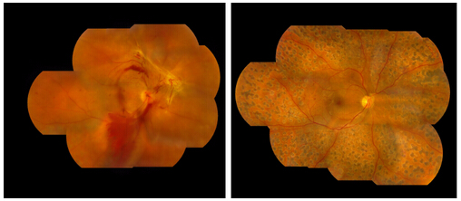 玻璃體視網(wǎng)膜,?，斎鹨曆劭?上海眼科醫(yī)院