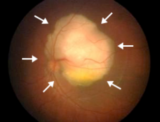 眼眶病,?，斎鹨曆劭?上海眼科醫(yī)院