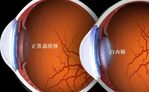 白內(nèi)障,?，斎鹨曆劭?上海眼科醫(yī)院