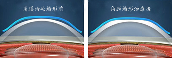 屈光矯視,?，斎鹨曆劭?上海眼科醫(yī)院