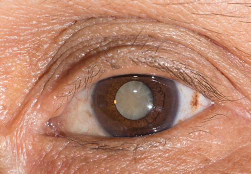 白內(nèi)障,希瑪瑞視眼科,上海眼科醫(yī)院