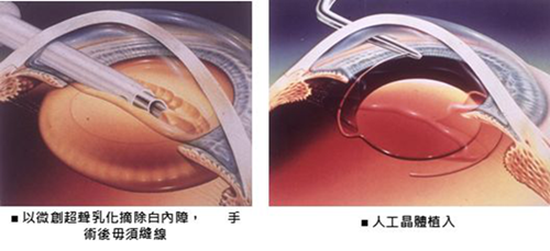 白內(nèi)障,?，斎鹨曆劭?上海眼科醫(yī)院