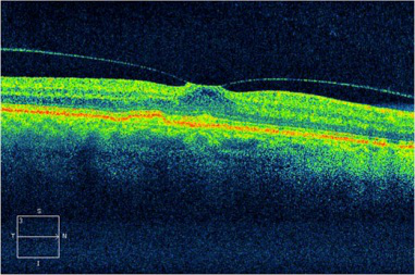 玻璃體視網(wǎng)膜,?，斎鹨曆劭?上海眼科醫(yī)院