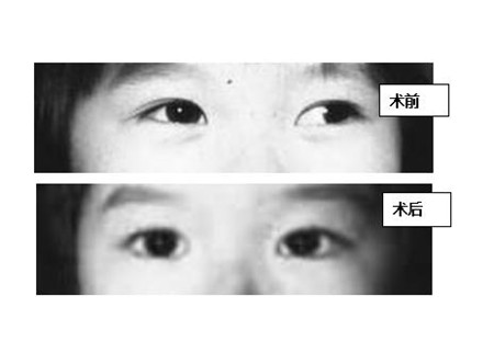 小兒眼病,?，斎鹨曆劭?上海眼科醫(yī)院