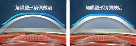 屈光矯視,?，斎鹨曆劭?上海眼科醫(yī)院