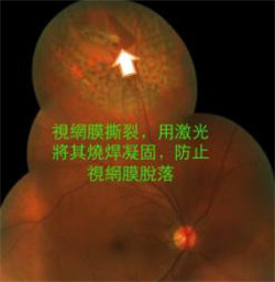 玻璃體視網(wǎng)膜,?，斎鹨曆劭?上海眼科醫(yī)院