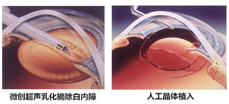 白內(nèi)障,?，斎鹨曆劭?上海眼科醫(yī)院