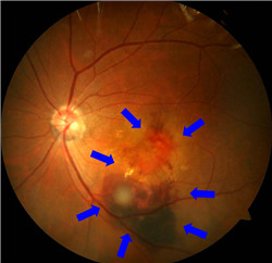 玻璃體視網(wǎng)膜,?，斎鹨曆劭?上海眼科醫(yī)院