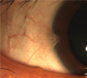 眼表眼角膜,?，斎鹨曆劭?上海眼科醫(yī)院