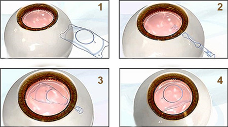 屈光矯視,?，斎鹨曆劭?上海眼科醫(yī)院