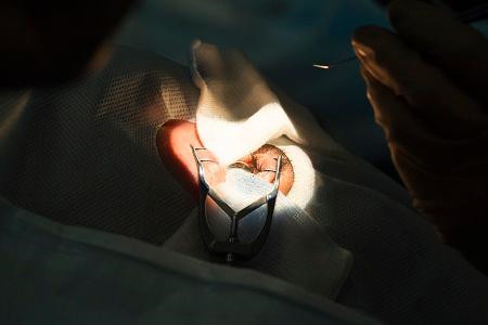 白內(nèi)障,?，斎鹨曆劭?上海眼科醫(yī)院