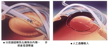 白內(nèi)障,希瑪瑞視眼科,上海眼科醫(yī)院