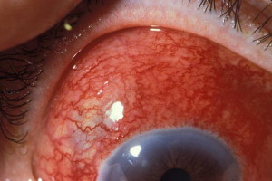 眼表眼角膜,?，斎鹨曆劭?上海眼科醫(yī)院