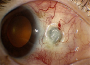 眼表眼角膜,希瑪瑞視眼科,上海眼科醫(yī)院