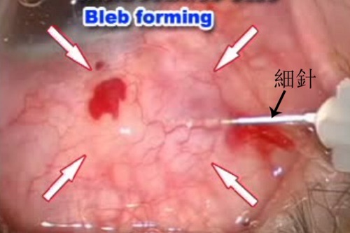 青光眼,希瑪瑞視眼科,上海眼科醫(yī)院