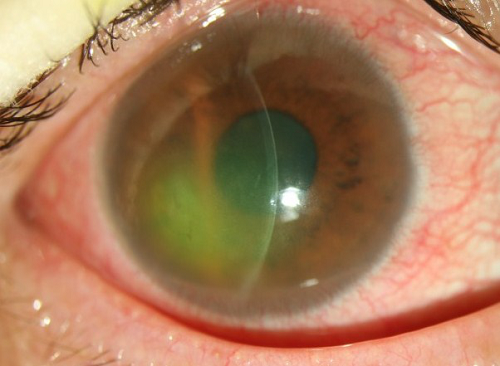 眼表眼角膜,?，斎鹨曆劭?上海眼科醫(yī)院