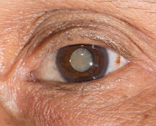 眼表眼角膜,?，斎鹨曆劭?上海眼科醫(yī)院