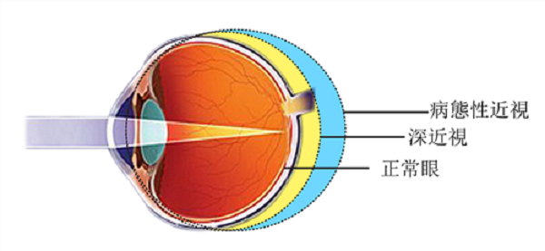 玻璃體視網(wǎng)膜,希瑪瑞視眼科,上海眼科醫(yī)院