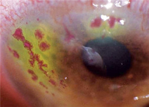 眼表眼角膜,?，斎鹨曆劭?上海眼科醫(yī)院