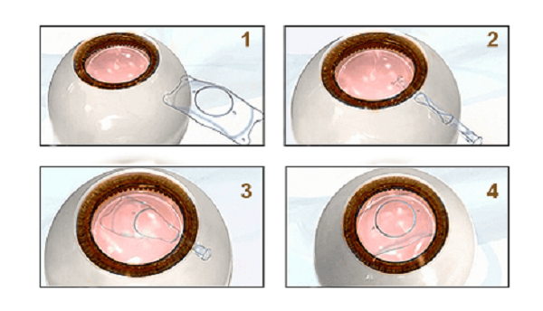 屈光矯視,?，斎鹨曆劭?上海眼科醫(yī)院