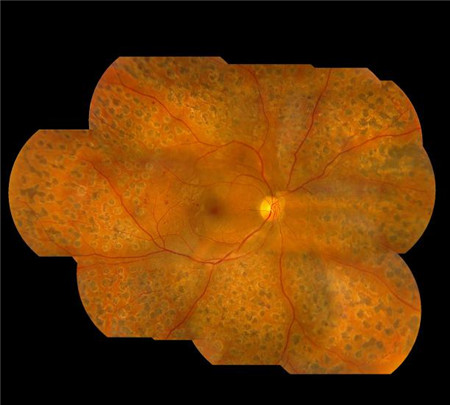 玻璃體視網(wǎng)膜,?，斎鹨曆劭?上海眼科醫(yī)院