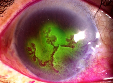 眼表眼角膜,希瑪瑞視眼科,上海眼科醫(yī)院