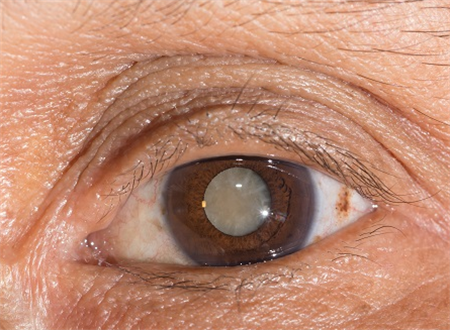 白內(nèi)障,?，斎鹨曆劭?上海眼科醫(yī)院