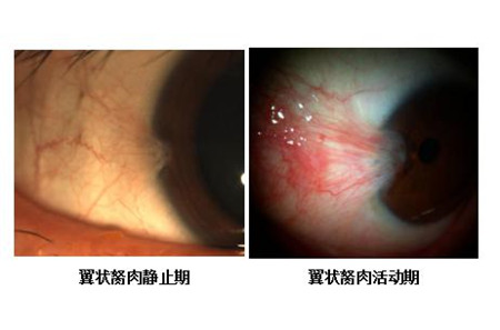 眼表眼角膜,?，斎鹨曆劭?上海眼科醫(yī)院