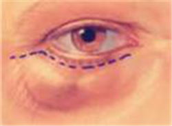 眼眶病,?，斎鹨曆劭?上海眼科醫(yī)院