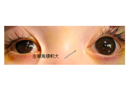 青光眼,?，斎鹨曆劭?上海眼科醫(yī)院