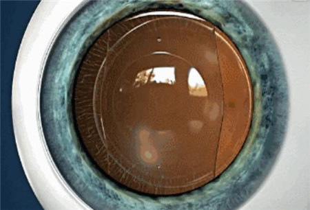 屈光矯視,?，斎鹨曆劭?上海眼科醫(yī)院