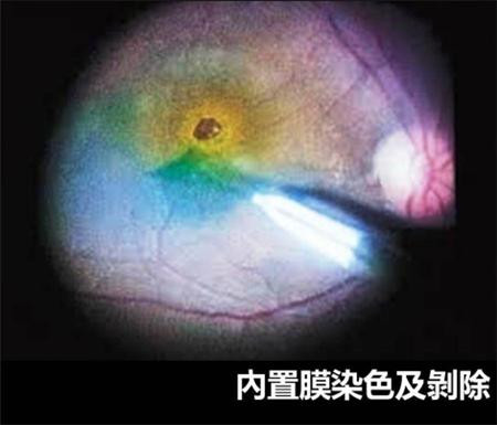 玻璃體視網(wǎng)膜,?，斎鹨曆劭?上海眼科醫(yī)院