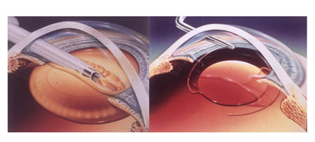 白內(nèi)障,希瑪瑞視眼科,上海眼科醫(yī)院