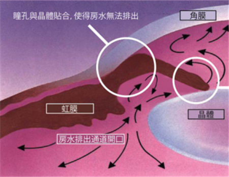 青光眼,?，斎鹨曆劭?上海眼科醫(yī)院