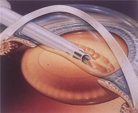 白內(nèi)障,?，斎鹨曆劭?上海眼科醫(yī)院