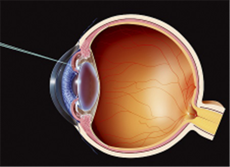 白內(nèi)障,?，斎鹨曆劭?上海眼科醫(yī)院