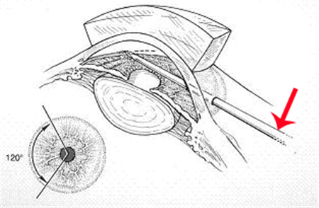 青光眼,?，斎鹨曆劭?上海眼科醫(yī)院
