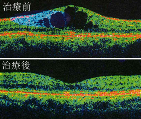 玻璃體視網(wǎng)膜,?，斎鹨曆劭?上海眼科醫(yī)院