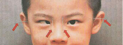 小兒眼病,?，斎鹨曆劭?上海眼科醫(yī)院