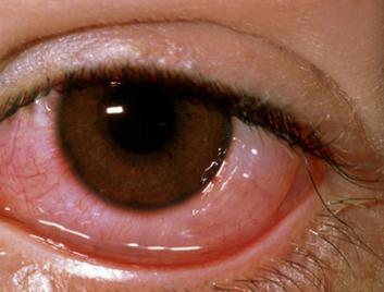 眼表眼角膜,?，斎鹨曆劭?上海眼科醫(yī)院