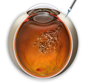 玻璃體視網(wǎng)膜,?，斎鹨曆劭?上海眼科醫(yī)院